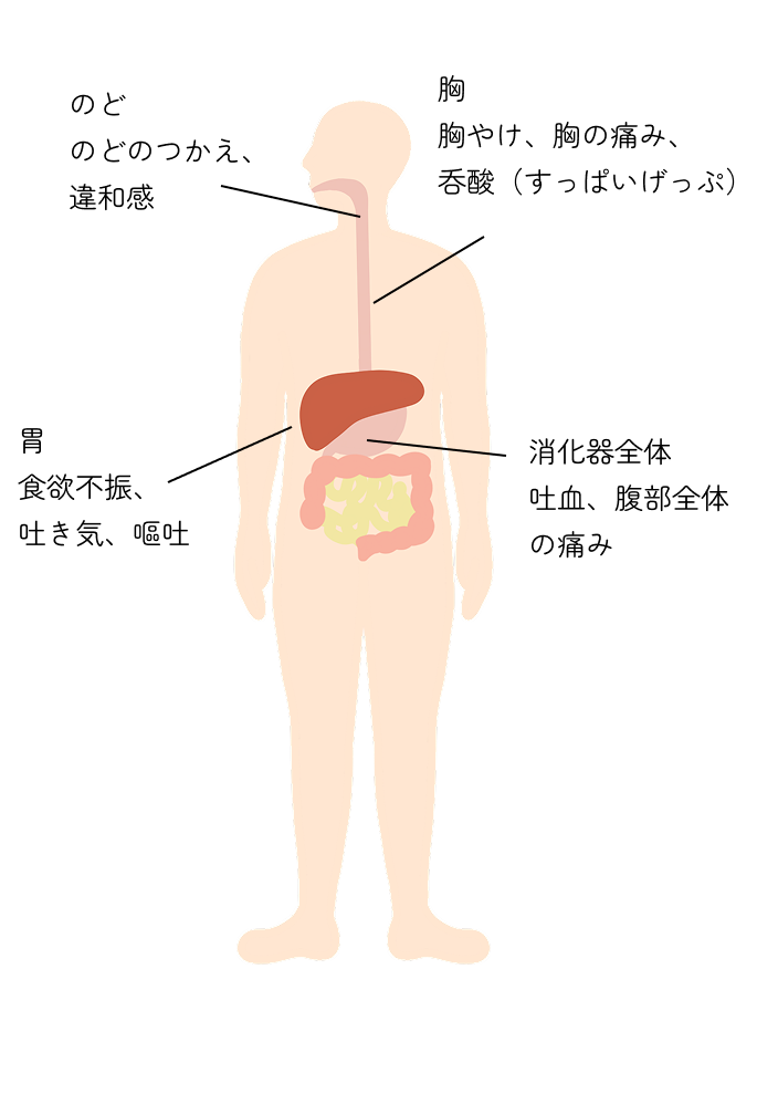人体のイラスト。のどのつかえ、のどの違和感、胸やけ、胸の痛み、呑酸（すっぱいげっぷ）、食欲不振、
吐き気、嘔吐、吐血、腹部全体の痛み